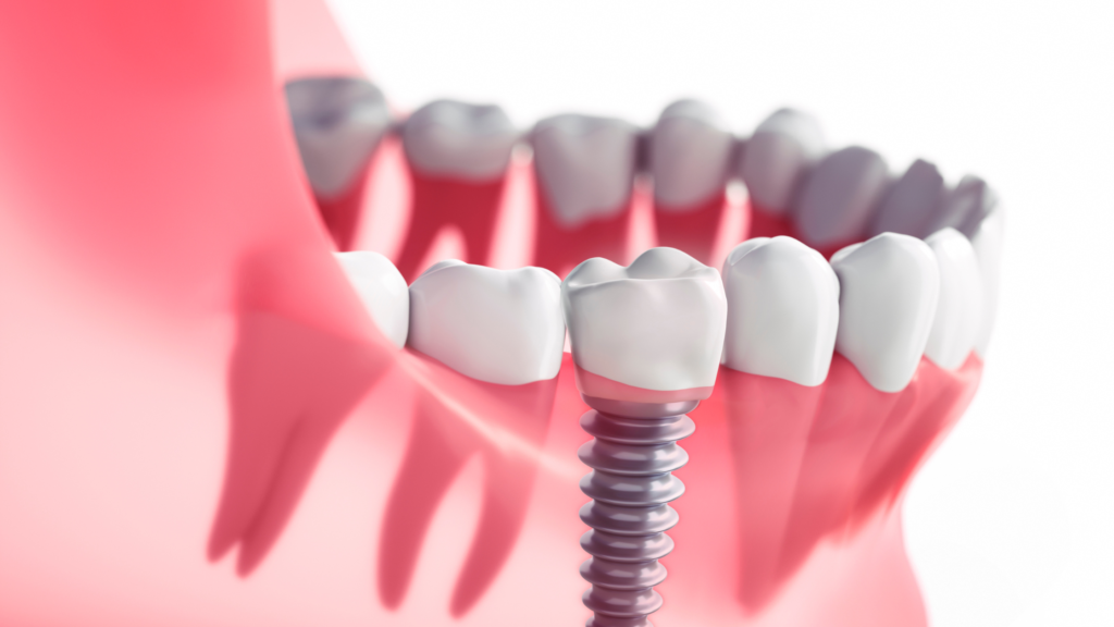 How Many Days Are Needed for Dental Implants in India? A Complete Timeline Guide homepage slider for clothing brand website sale (blog banner) (31)