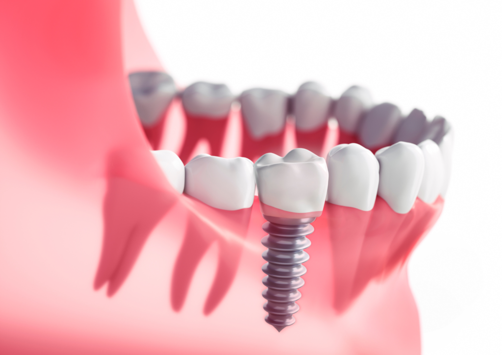 How Many Days Are Needed for Dental Implants in India? A Complete Timeline Guide landscape